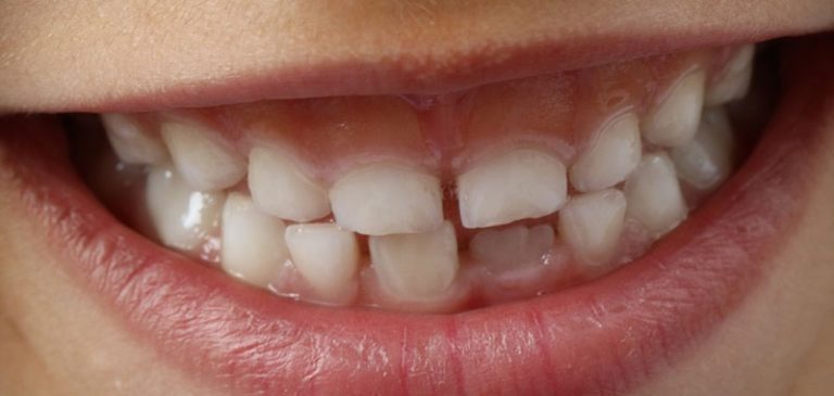 Ragazzino lamenta dolori: gli estraggono 526 denti