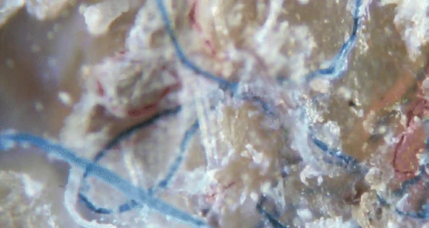 Malattia di Morgellons mutazione genetica o scie chimiche