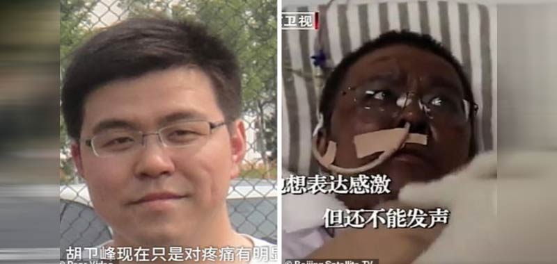 Medici di Wuhan cambiano colore della pelle dopo il coronavirus