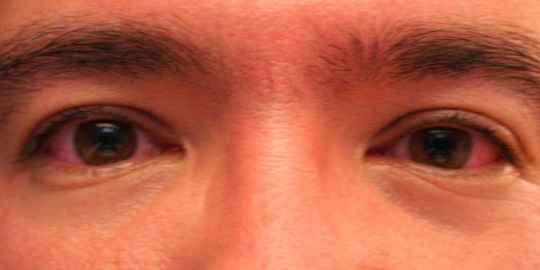 Covid-19: Cosa succede ai nostri occhi?