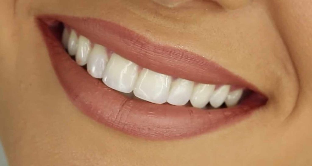 Sbiancamento dei denti esistono diverse tecniche