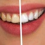 Cibi da evitare dopo la sbiancamento dei denti