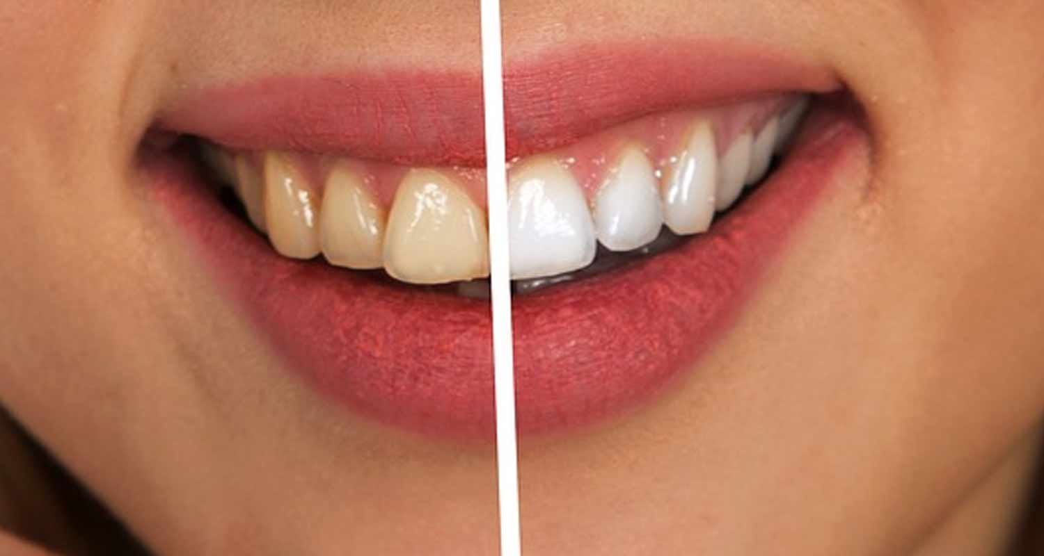 Cibi da evitare dopo la sbiancamento dei denti
