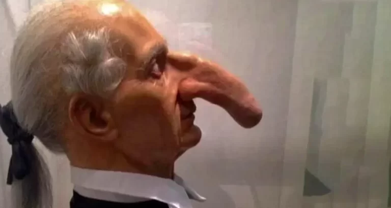 La triste storia dell’uomo col naso più lungo della storia