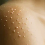Perché compaiono quei piccoli puntini bianchi sulla pelle